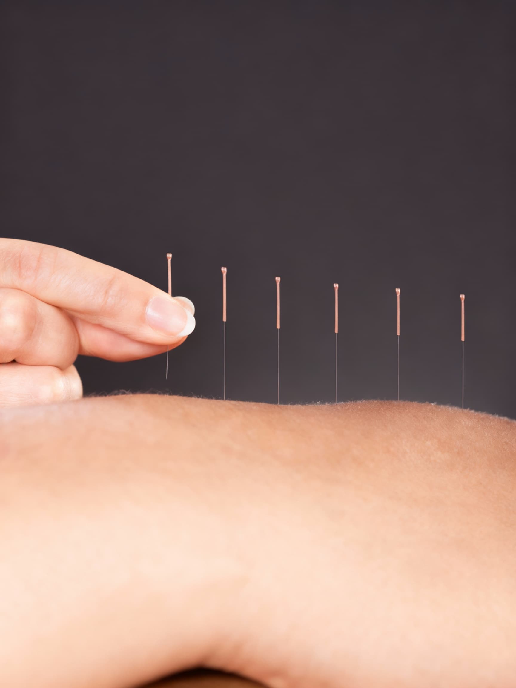 Akupunktur Nasıl Etki Eder